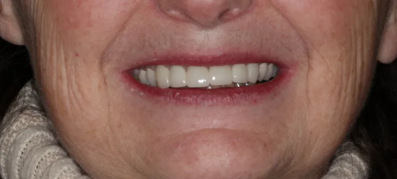 Patient's mouth after complete smile restoration