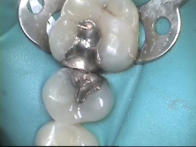 Amalgam filling before replacement