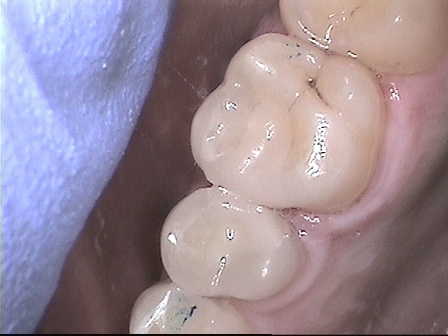 New composite filling on tooth
