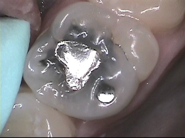 Amalgam filling with decay under it