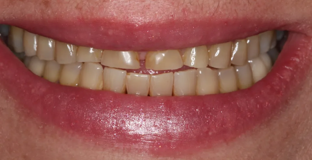 Patient's mouth before smile restoration