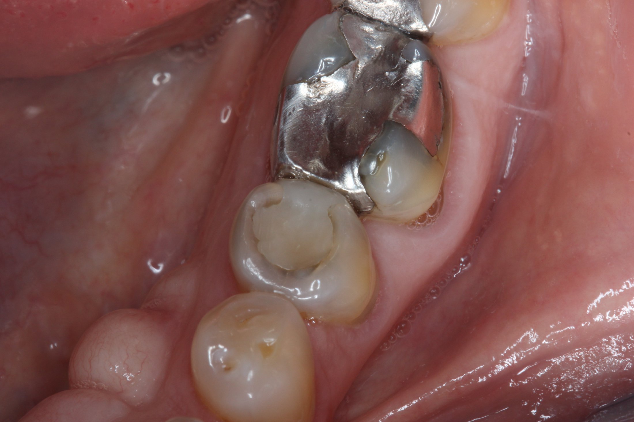 Patient's mouth before dental treatment