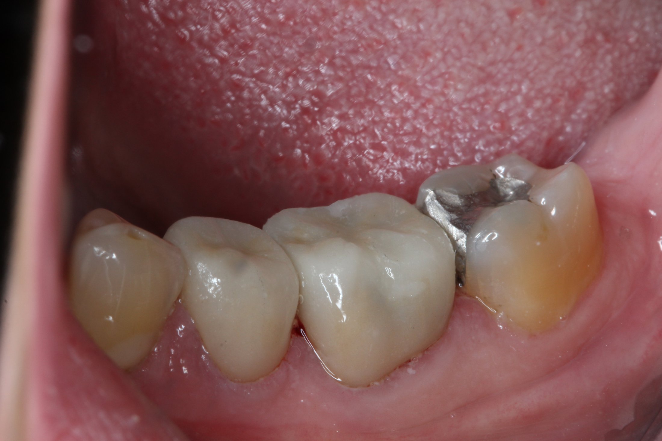 Patient's mouth after dental treatment