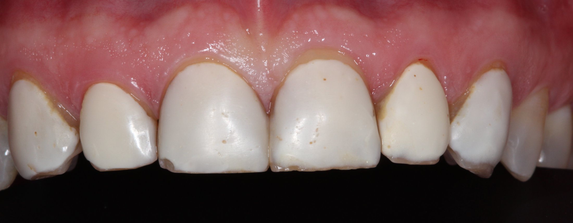 Patient's mouth before dental treatment