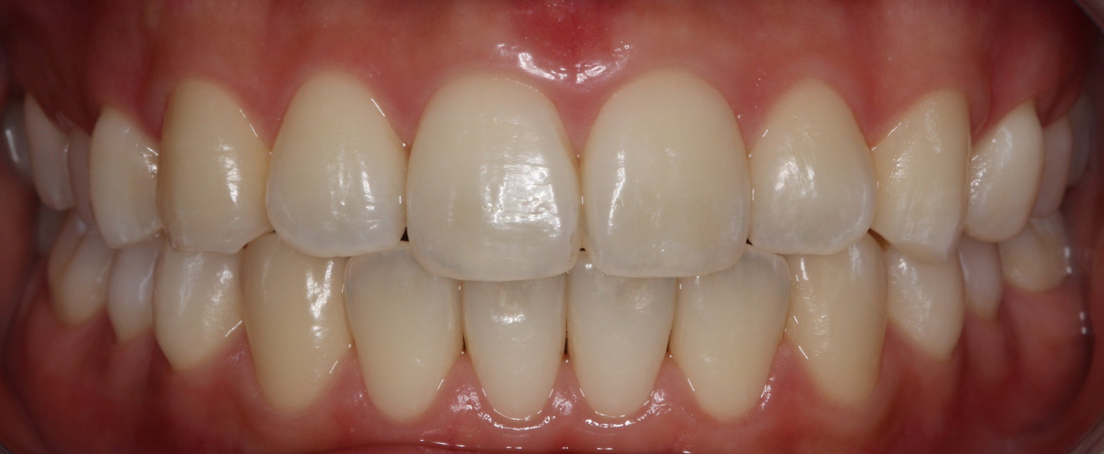 Patient's mouth before teeth whitening