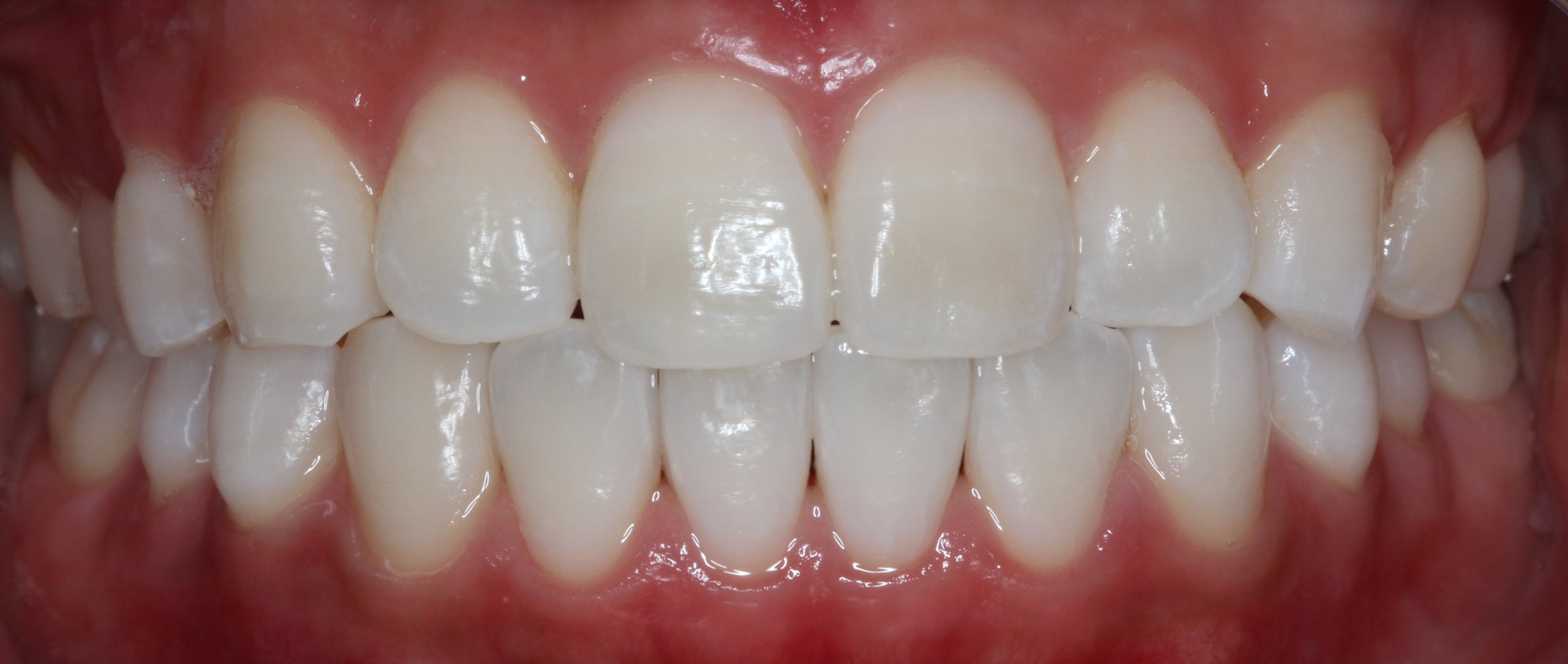 Patient's mouth after teeth whitening