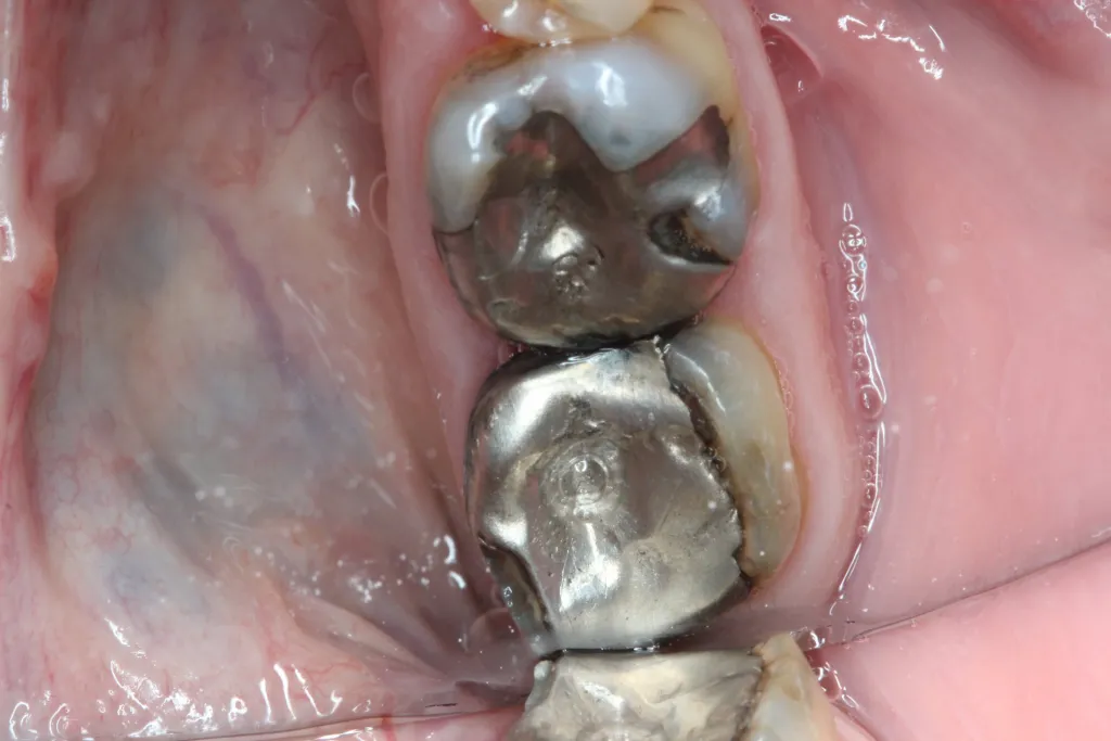 Patient's mouth before replacing amalgam fillings