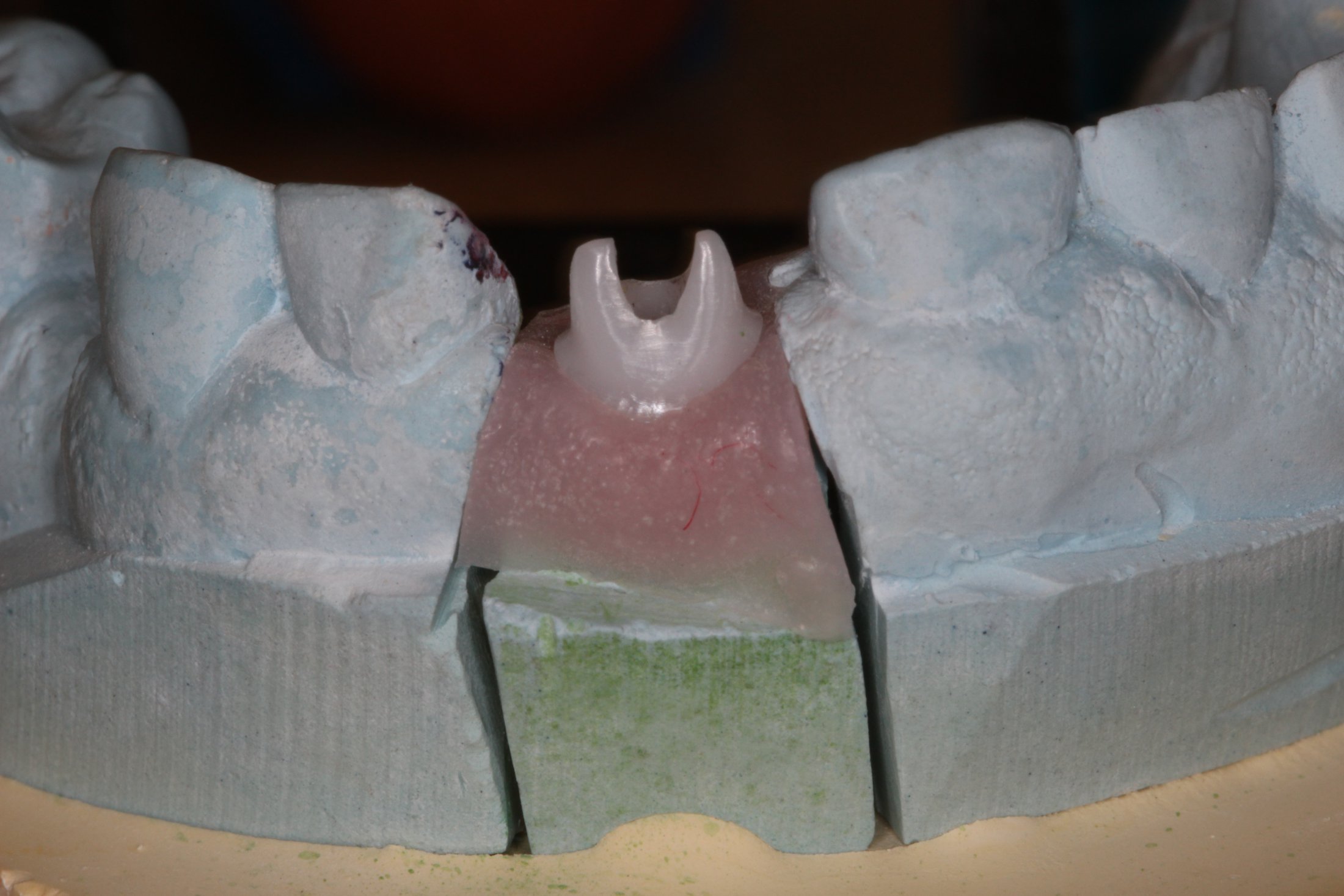 anchor for a single dental implant