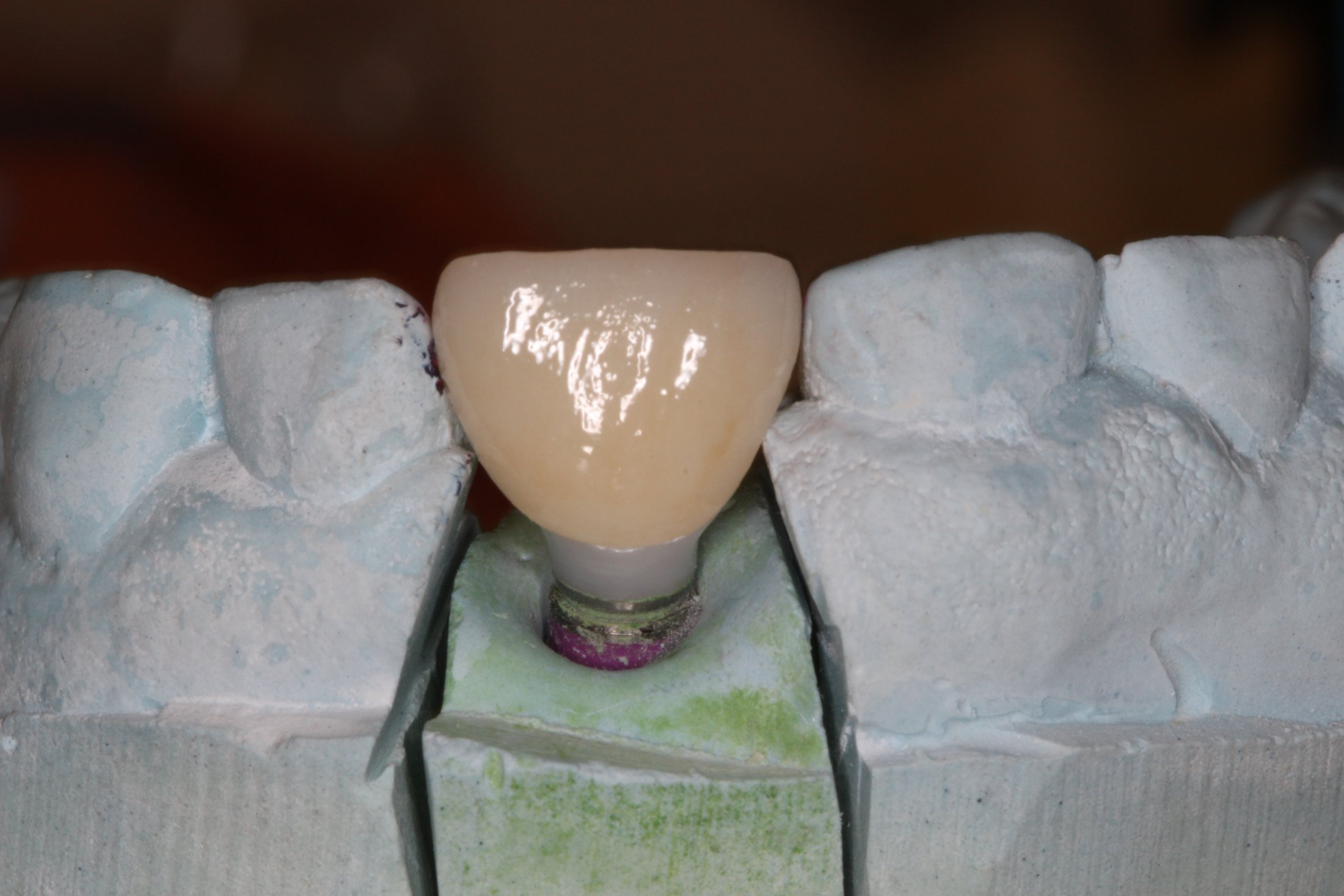example of a single implant