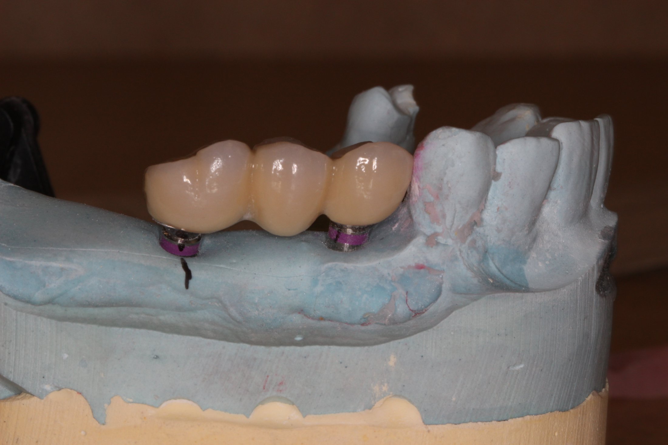 example of a posterior bridge