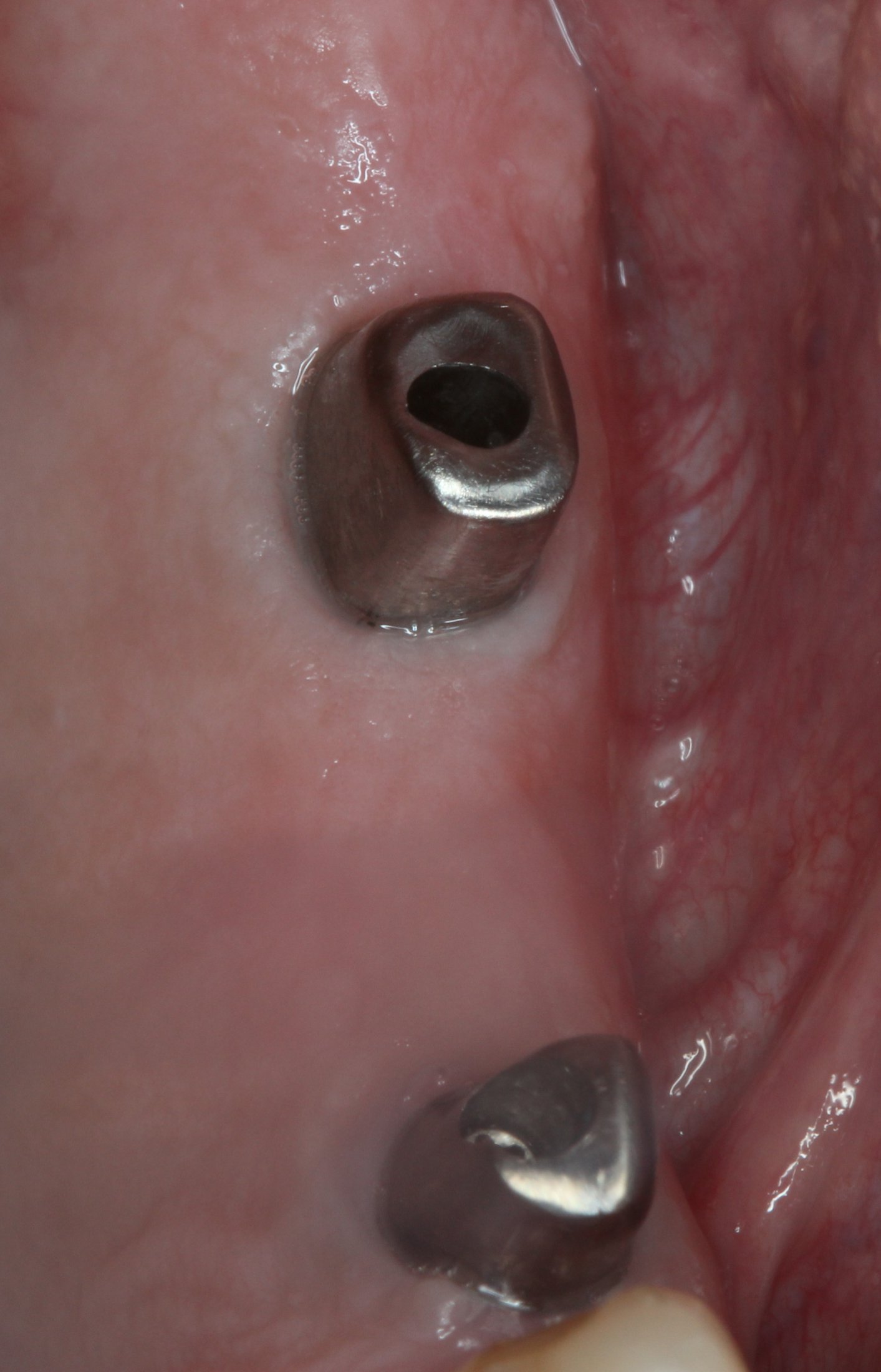 metal anchors for a posterior bridge
