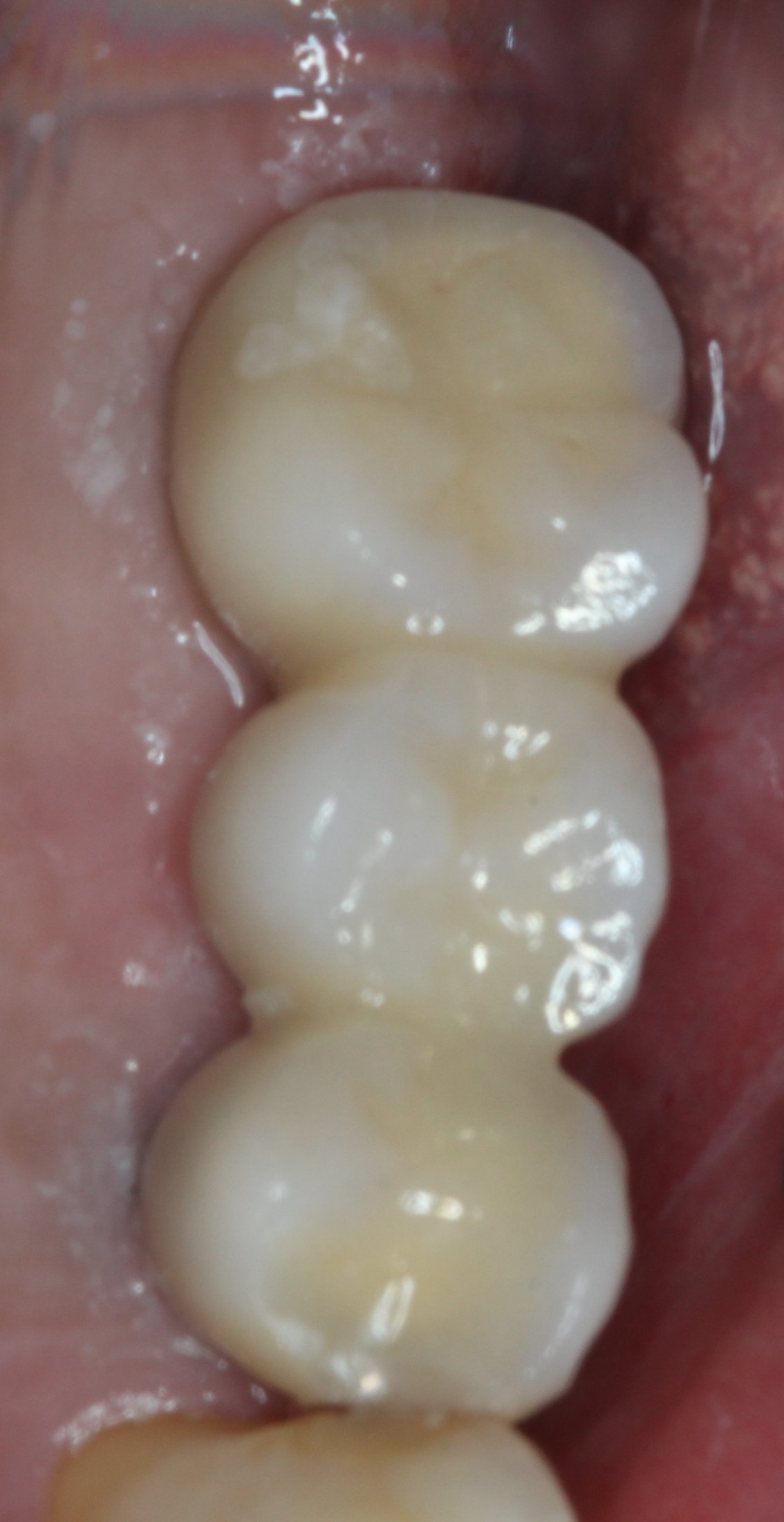 posterior bridge after placement in mouth