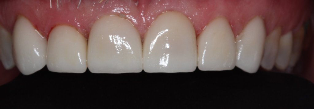 Patient's mouth after dental treatment