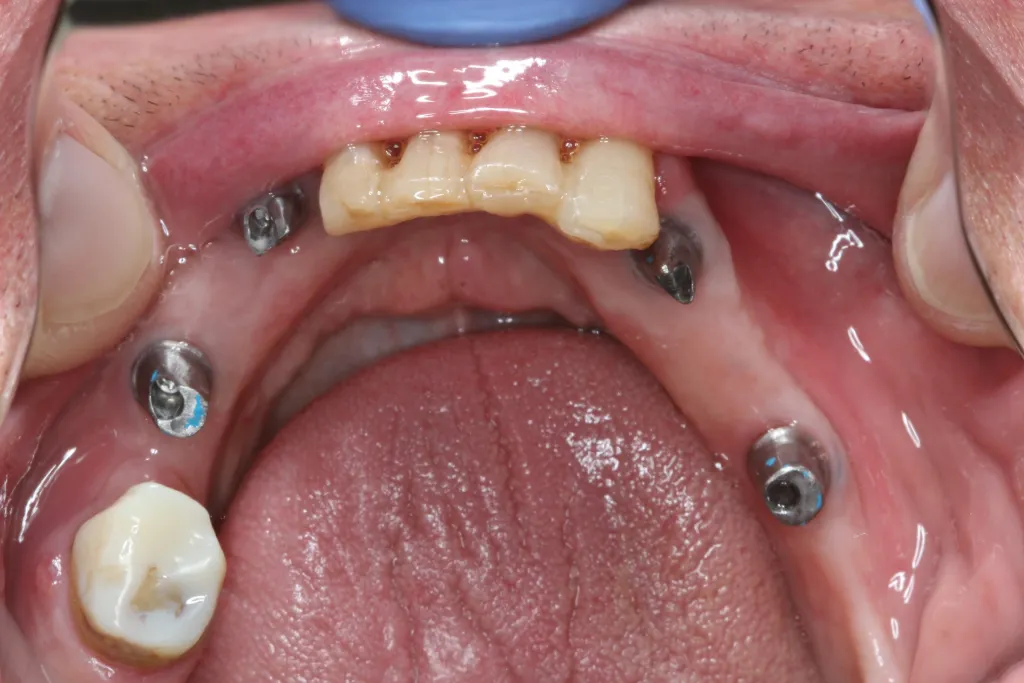 Patient's mouth with implant anchors