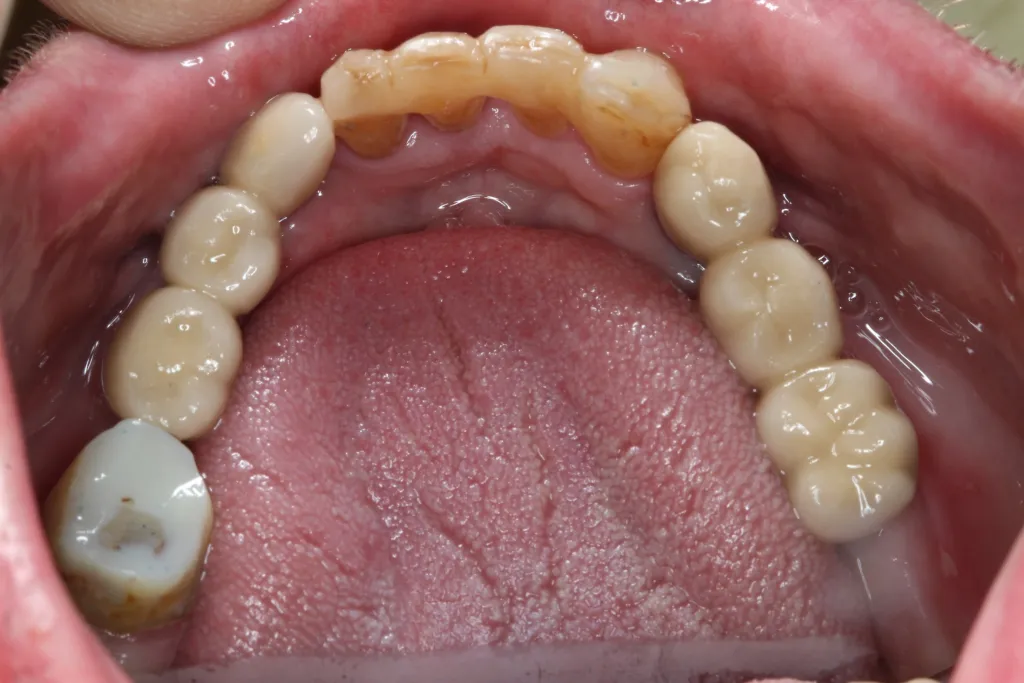 Patient's mouth after placing implants
