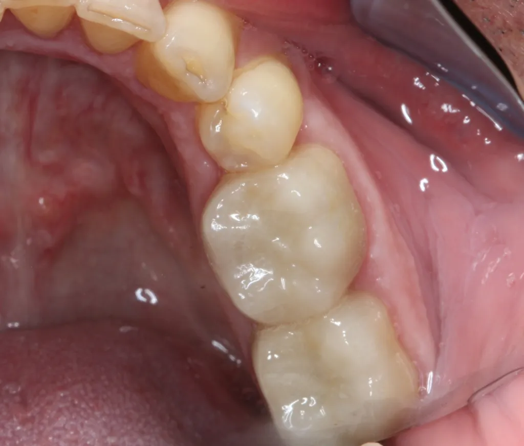 Patient's mouth with new composite fillings