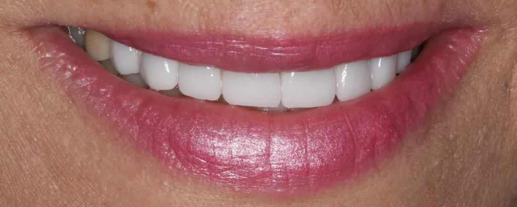 Patient's mouth after smile restoration