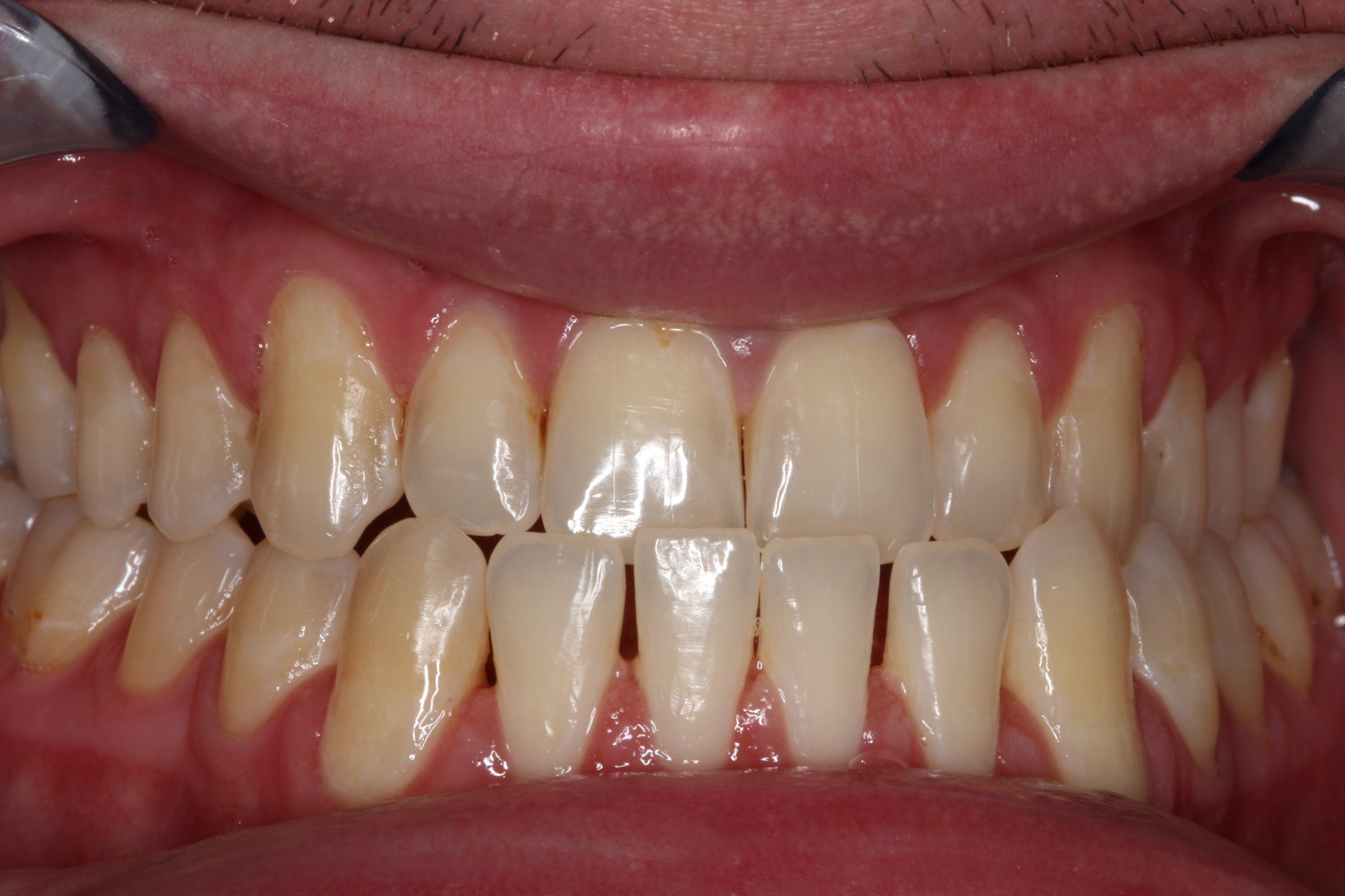 Patient's mouth before Invisalign