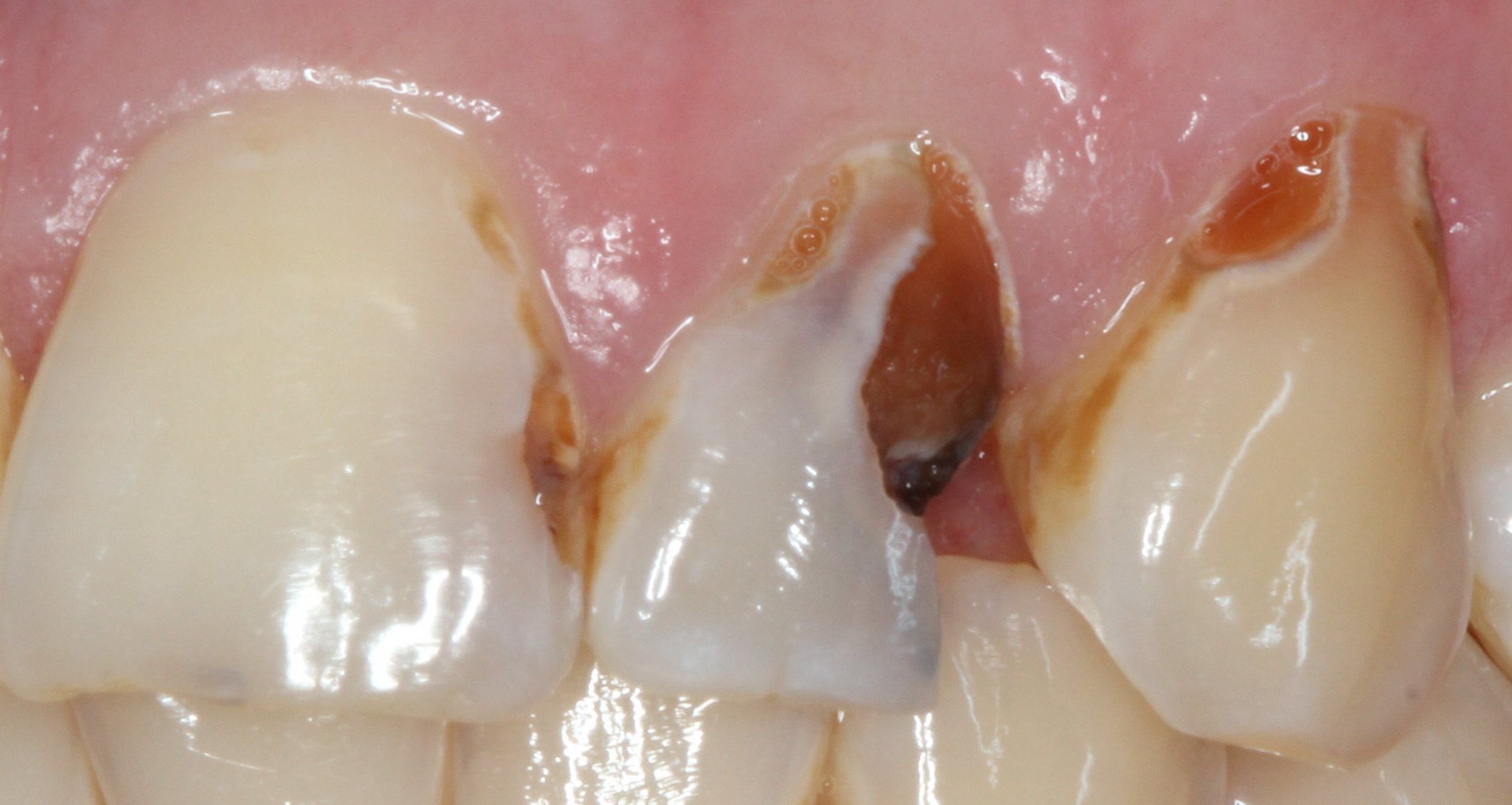 Patient's mouth before dental treatment on tooth