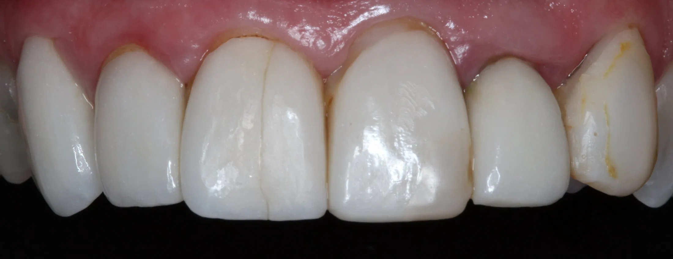 Patient's mouth before fixing cracked tooth