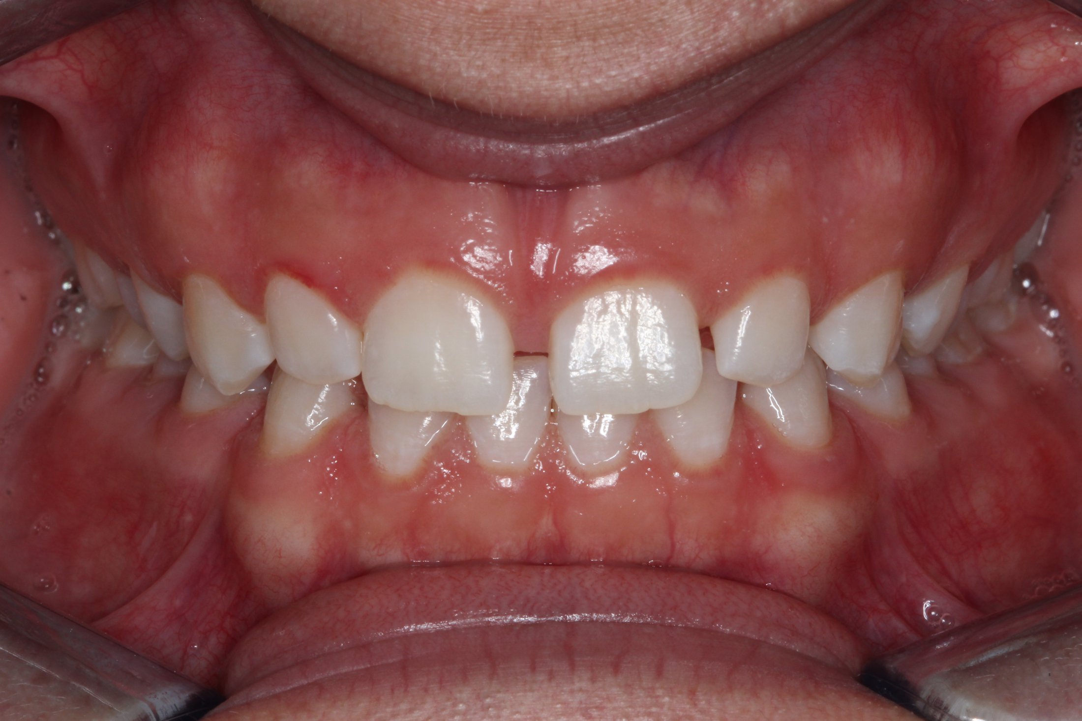 Patient's mouth before Invisalign