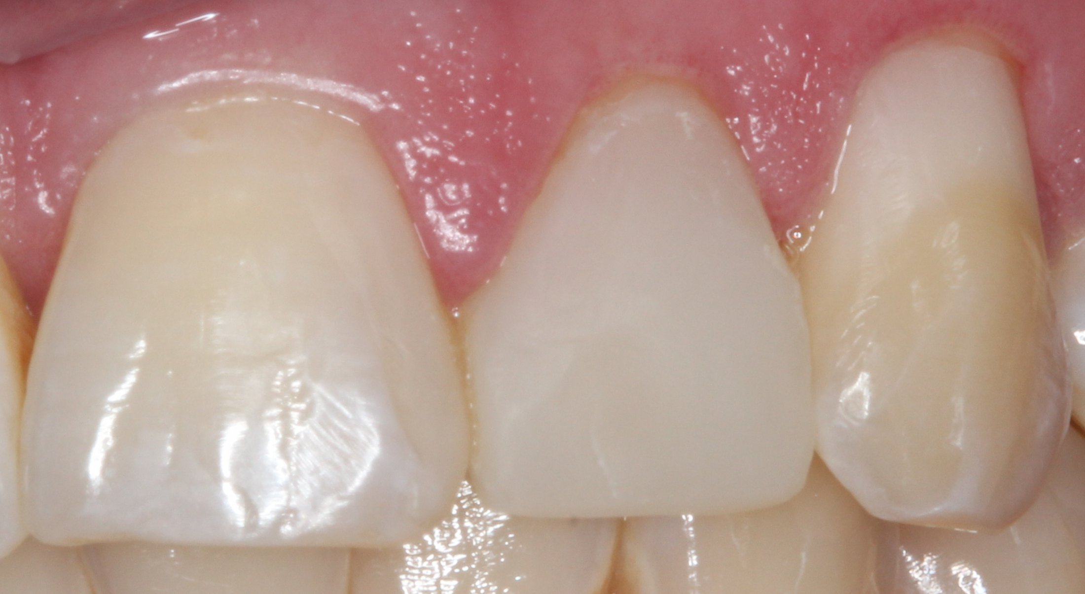 Patient's mouth after dental treatment on tooth