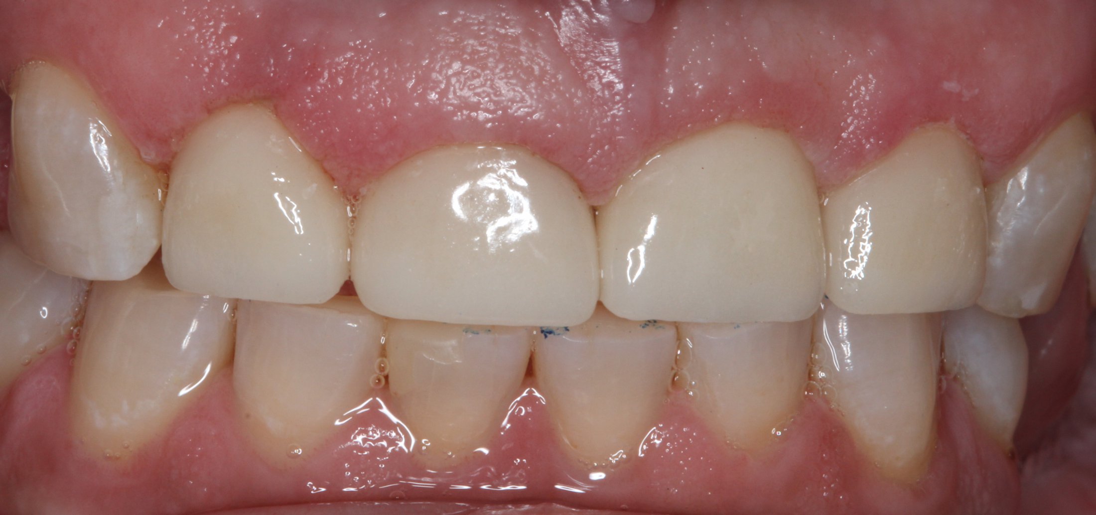 Patient's mouth with finished dental implants