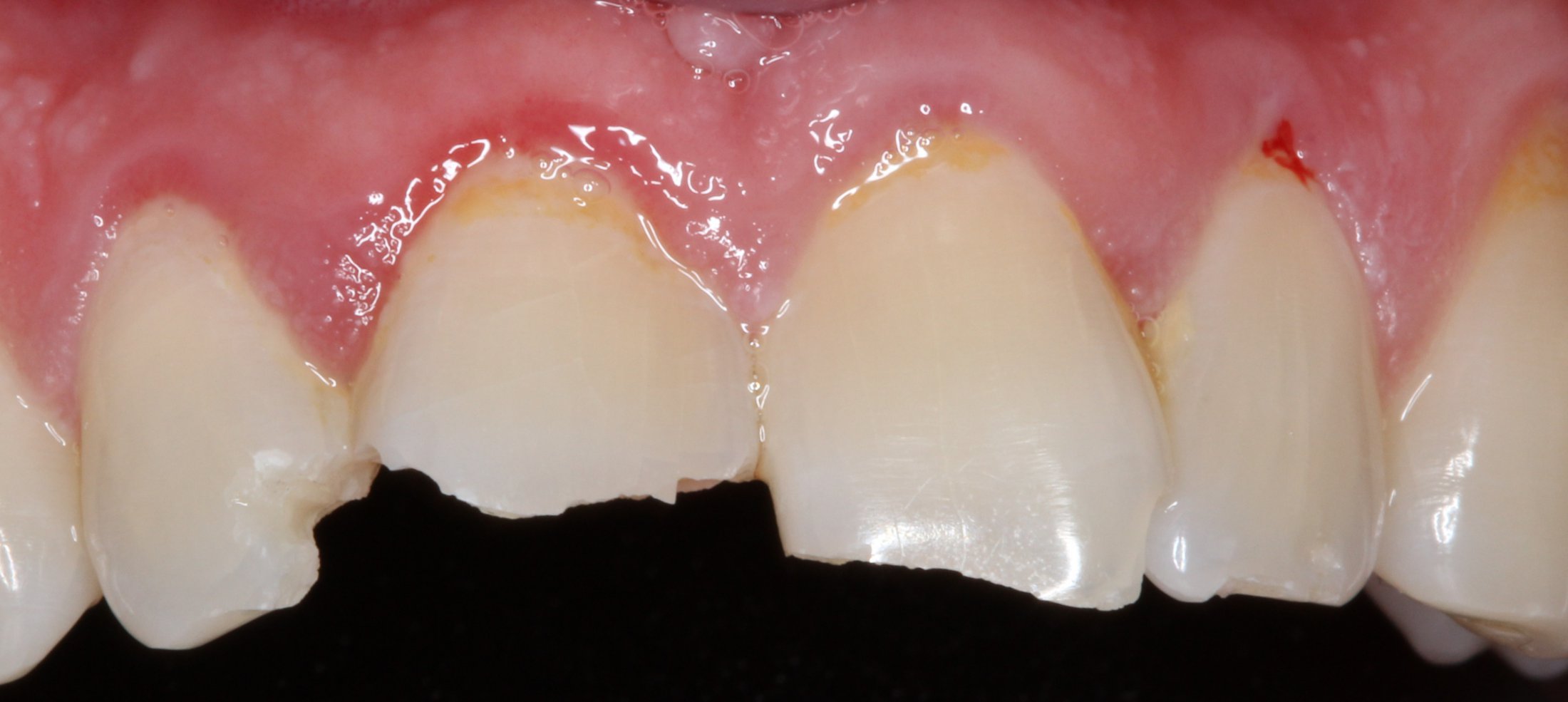 Patient's mouth before fixing chipped tooth