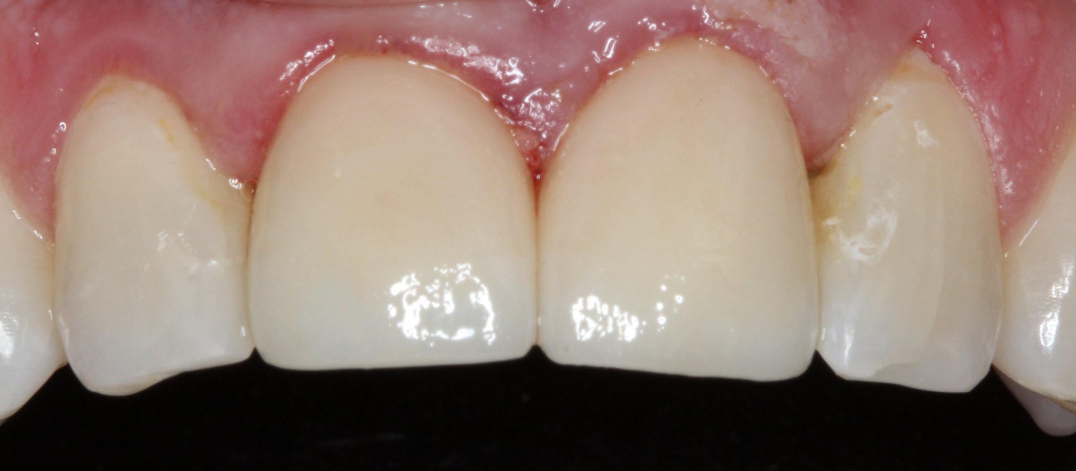 Patient's mouth after fixing chipped tooth