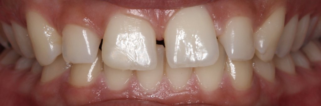 Patient's mouth before dental treatment