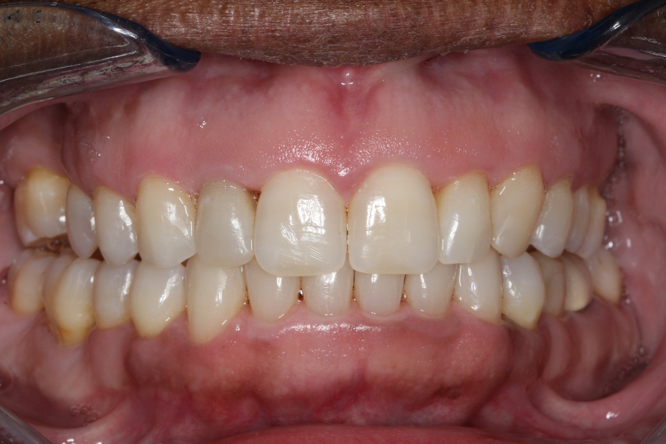 Patient's mouth after Invisalign
