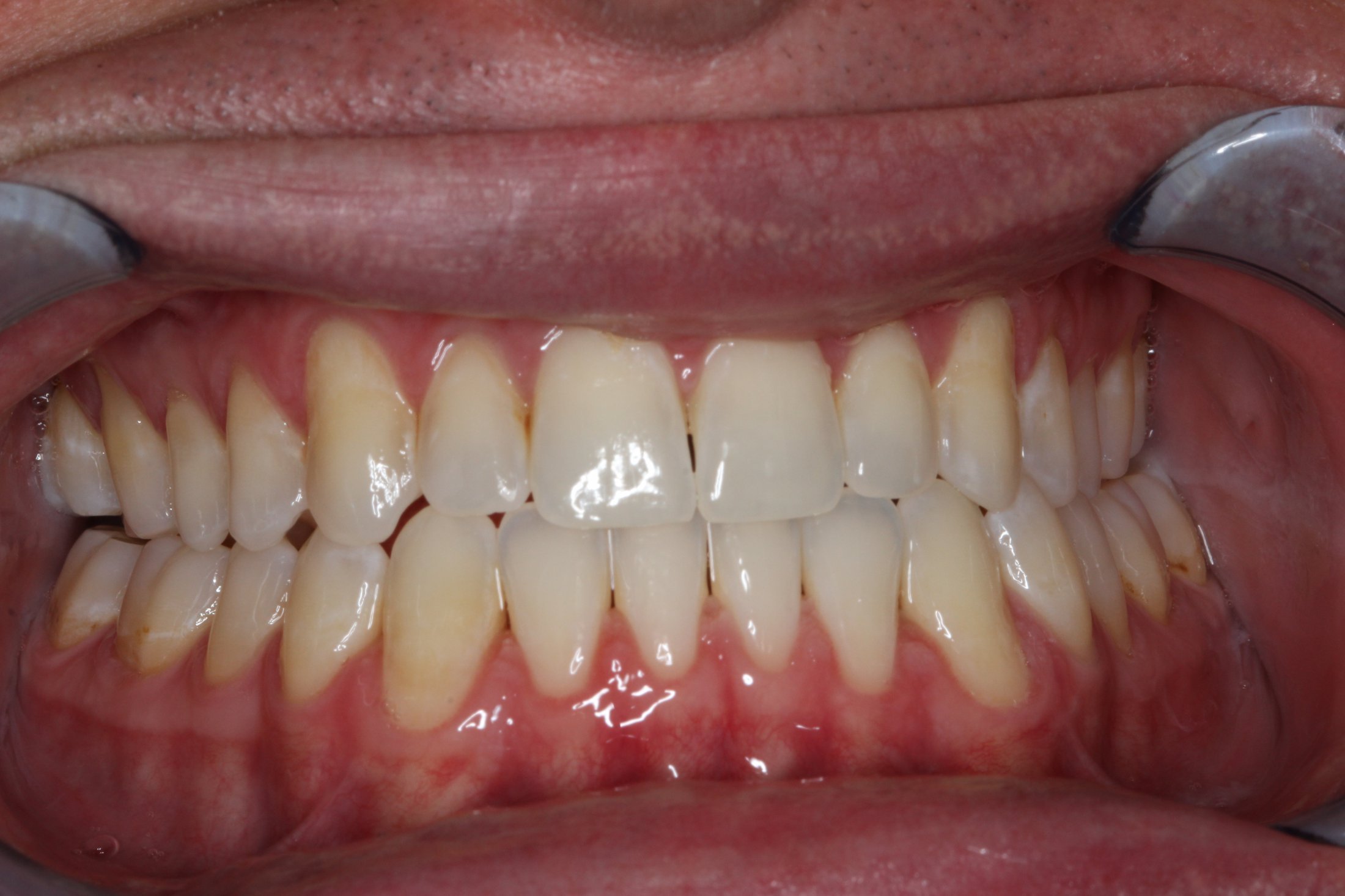 Patient's mouth after Invisalign