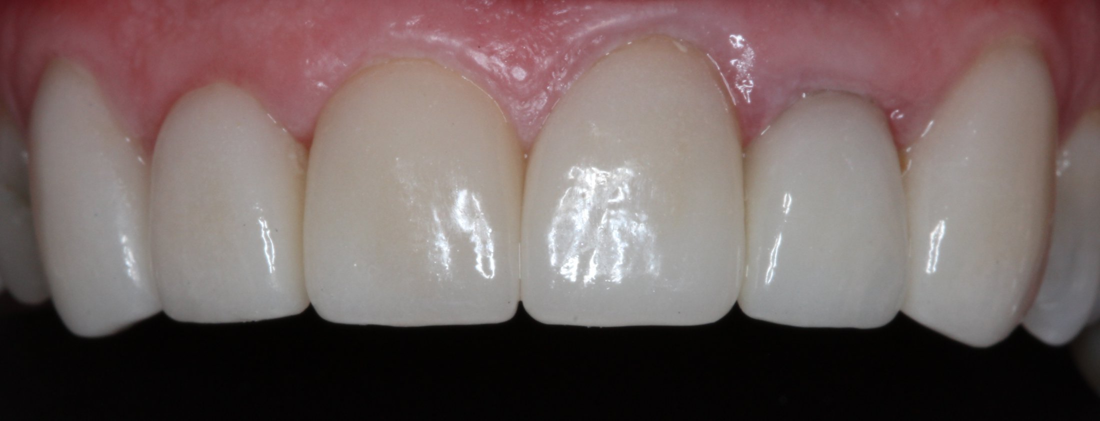 Patient's mouth after fixing cracked tooth