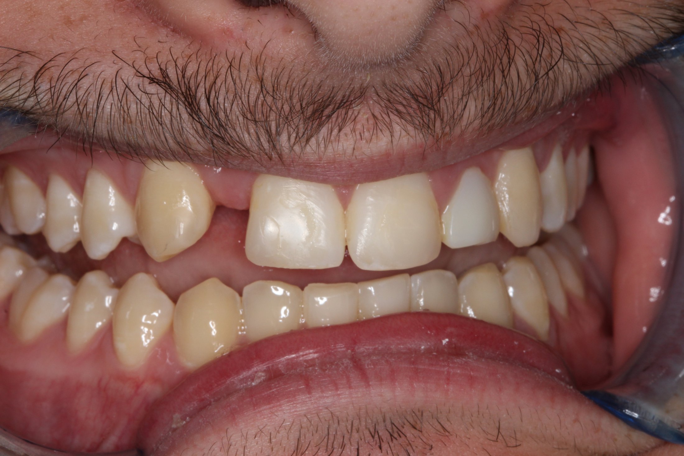 Patient's mouth before implant and smile restoration