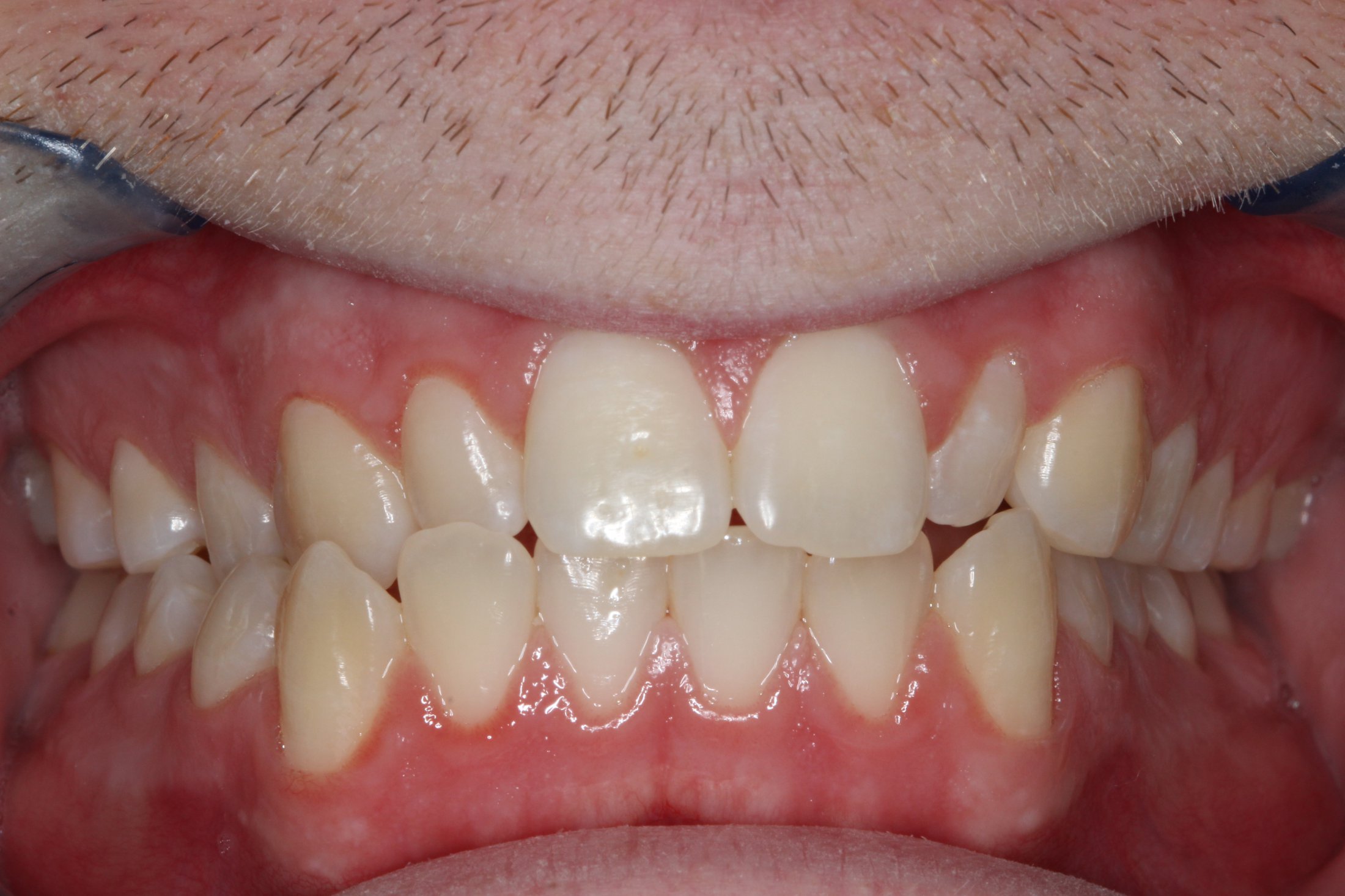 Patient's mouth before Invisalign