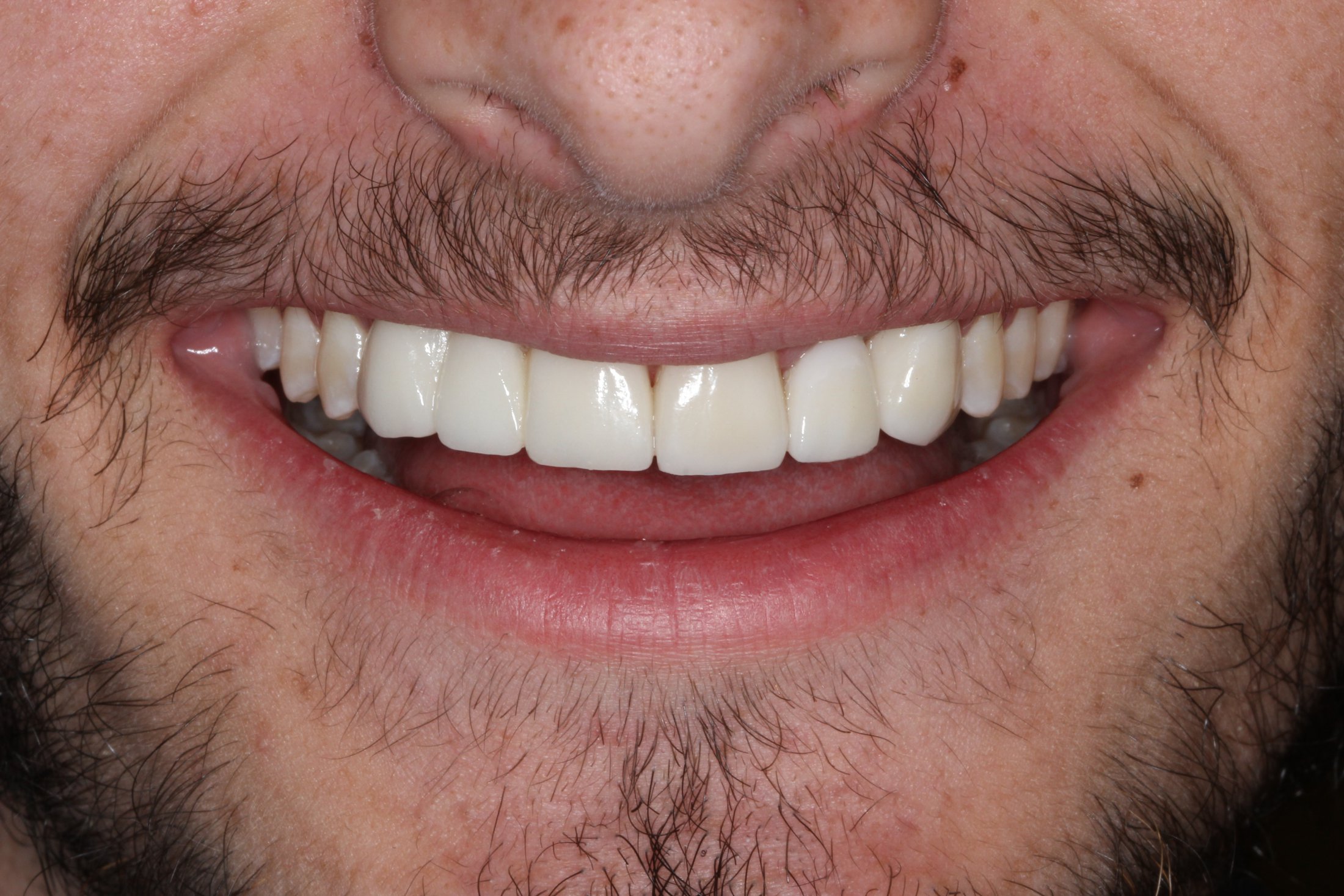 Patient's mouth after implant and smile restoration