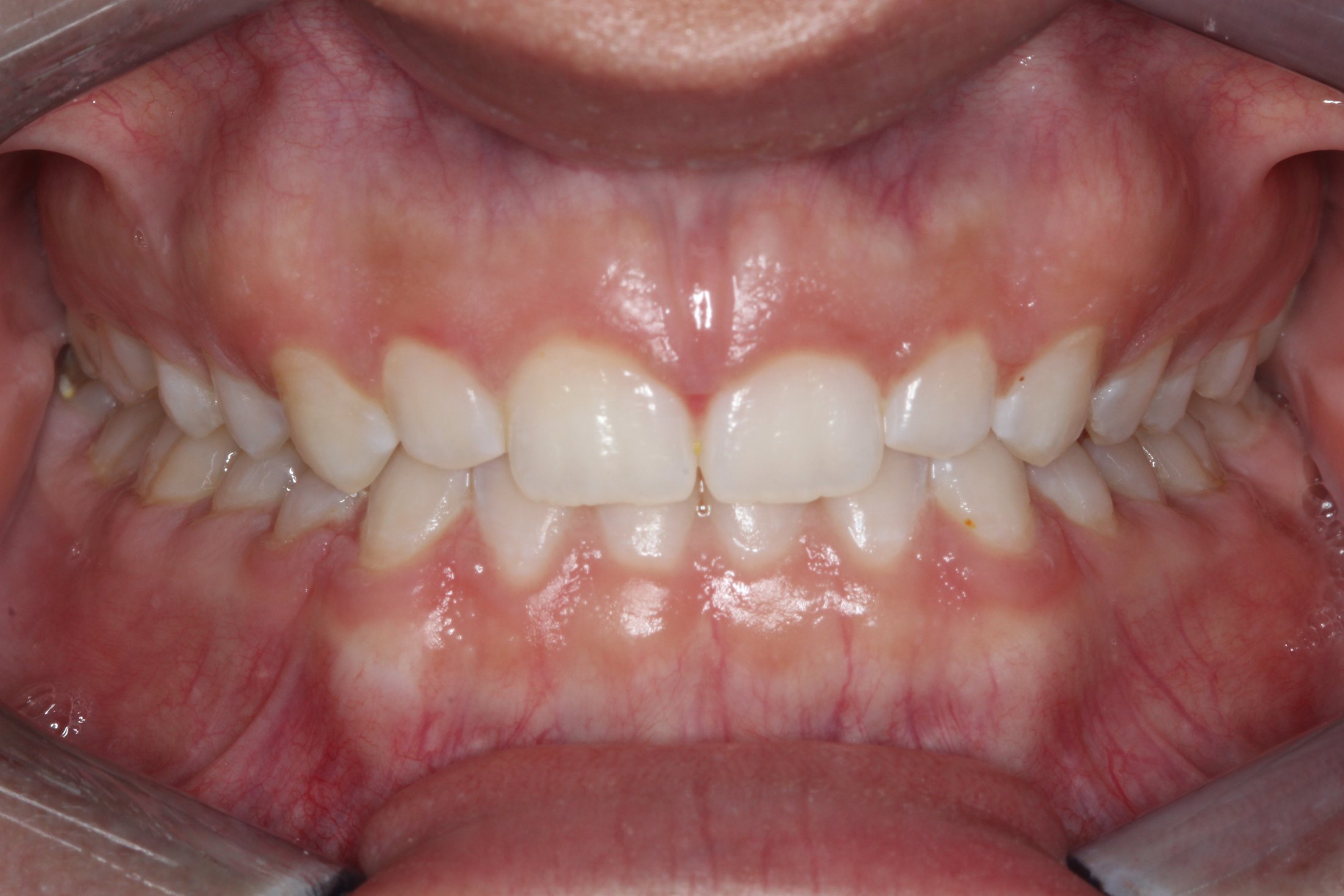 Patient's mouth after Invisalign