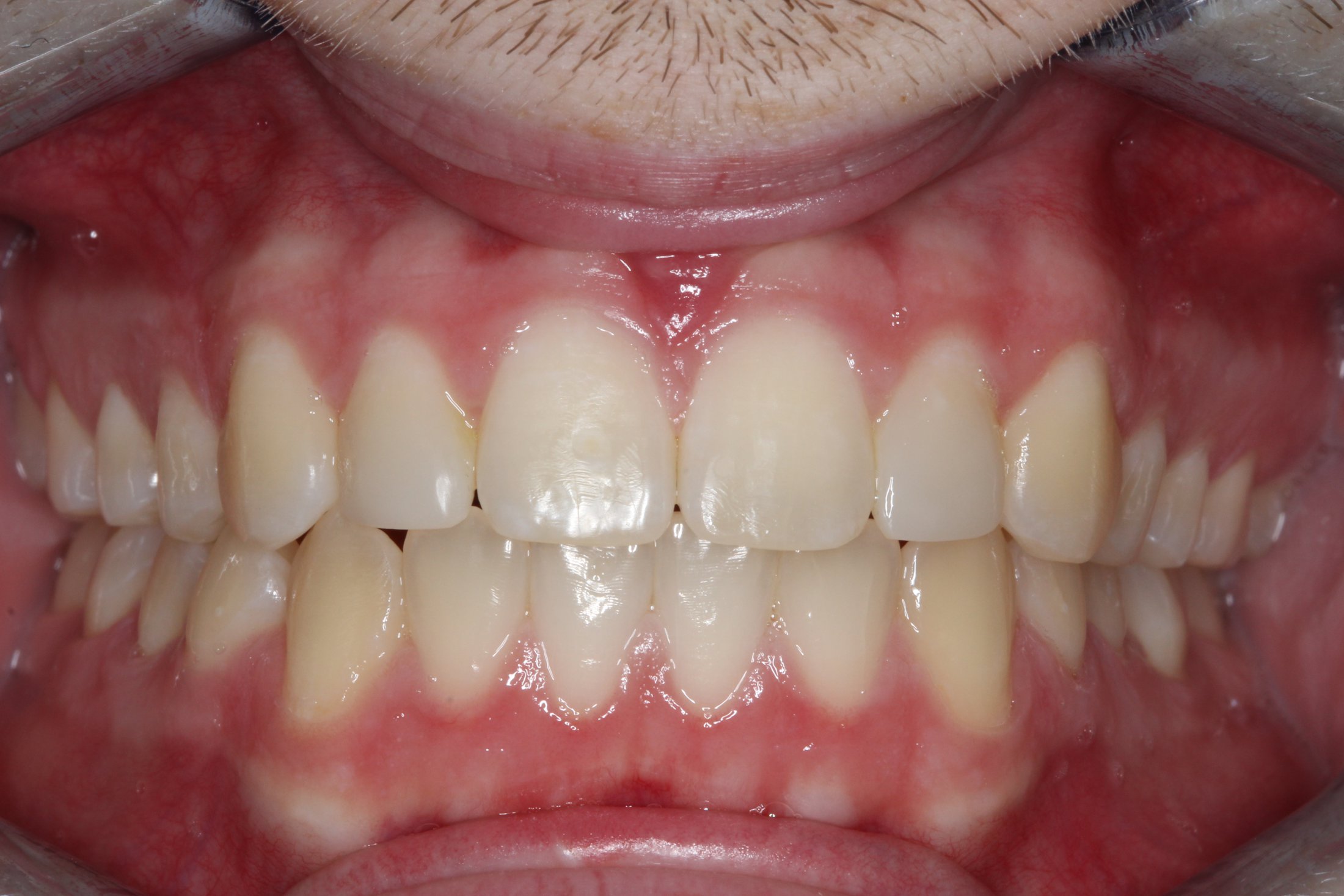 Patient's mouth after Invisalign