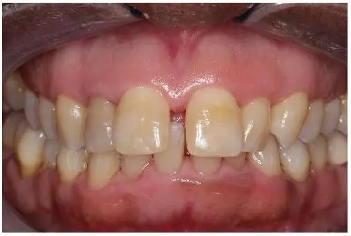 Patient's mouth before Invisalign
