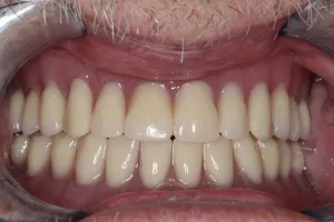 Patient's mouth after dental treatment