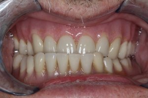 Patient's mouth before dental treatment