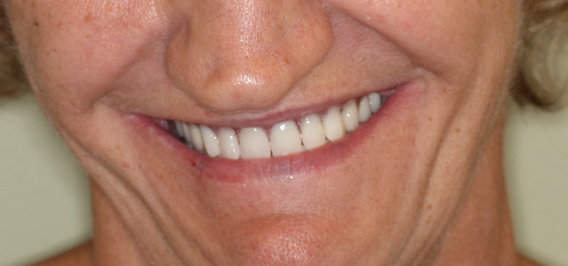 Patient's smile after dental treatment