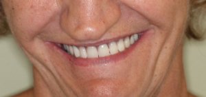 Woman with dentures smiling