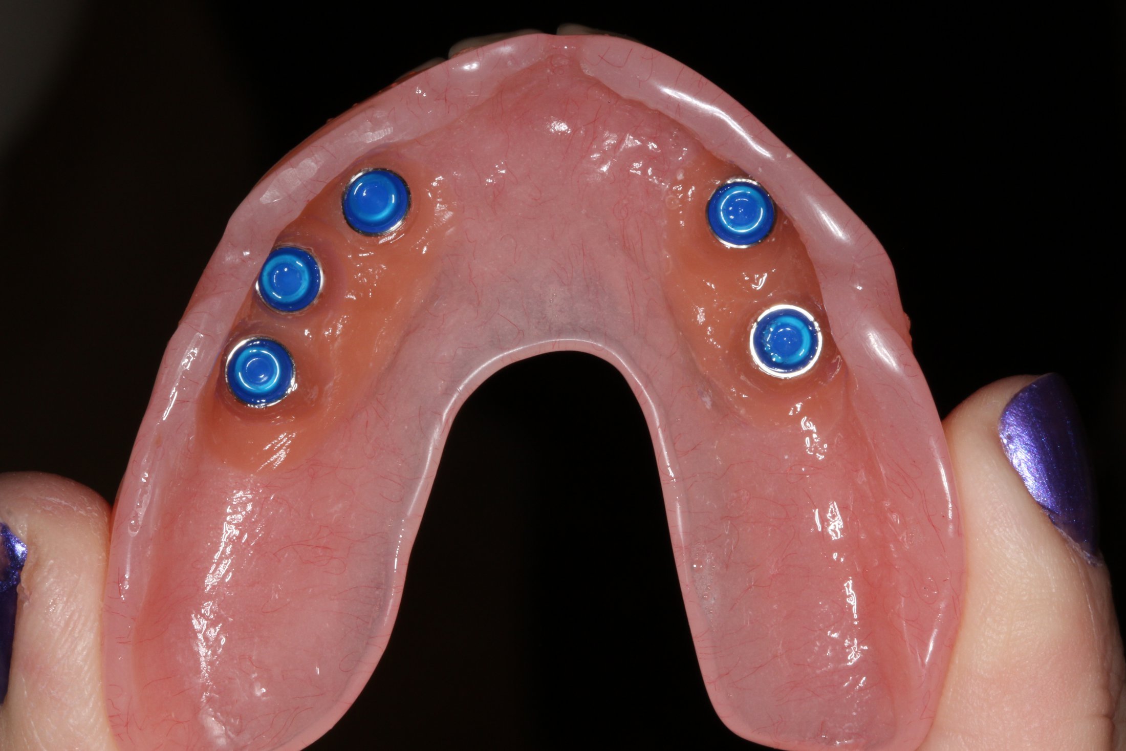Implant-attached denture