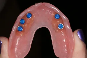 Implant retained denture