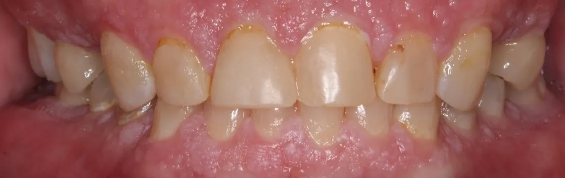 Patient's mouth before smile makeover