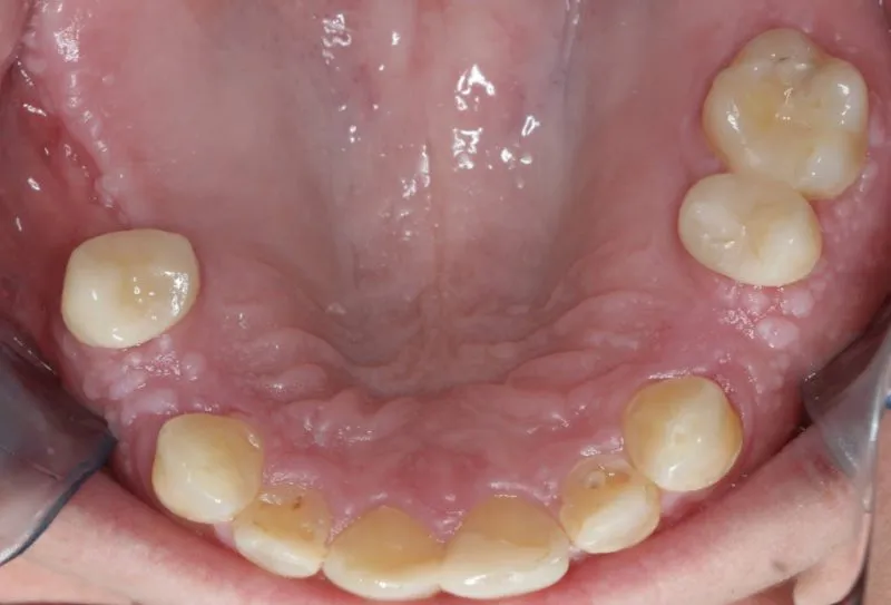 Patient's mouth before multiple implants