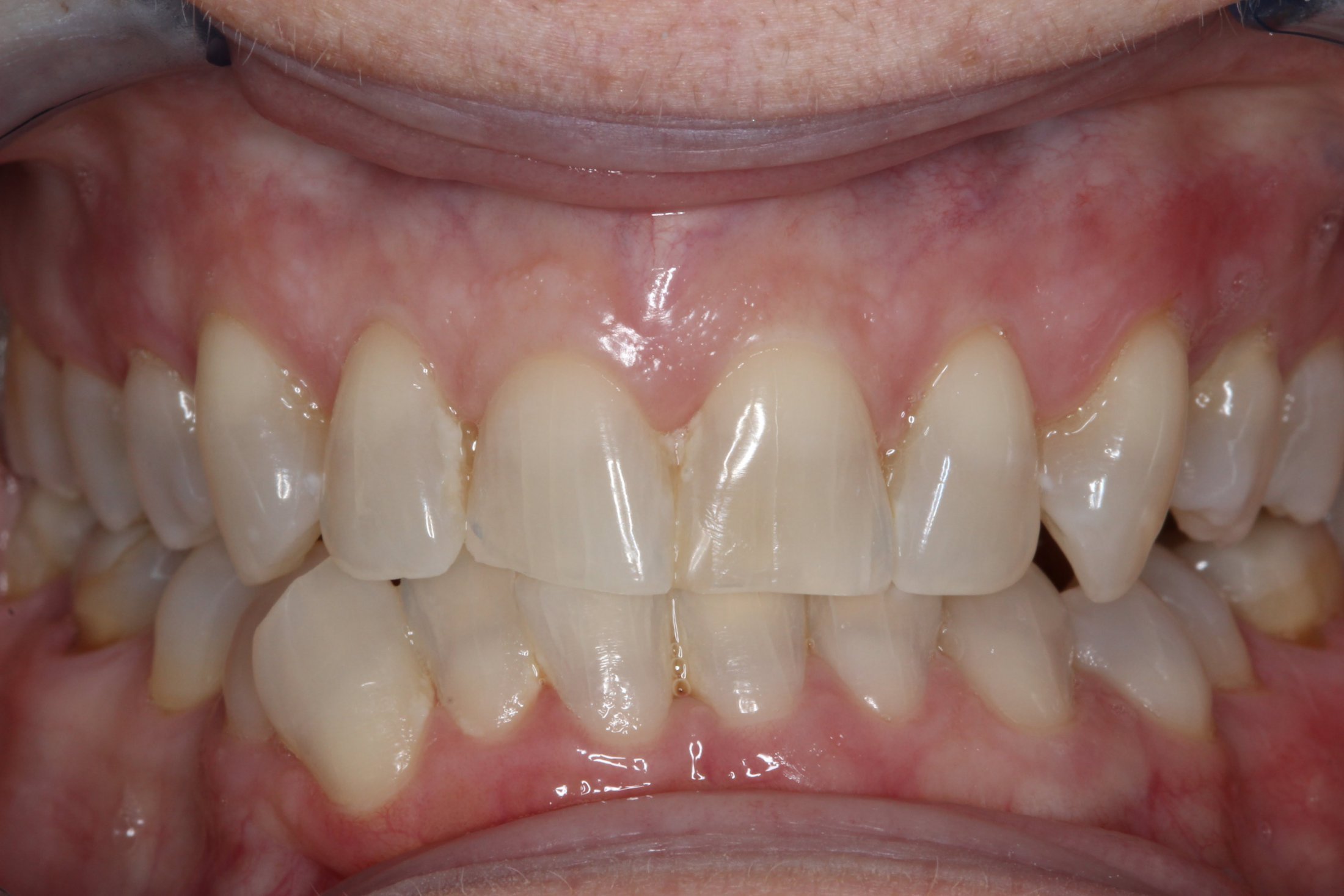 Patient's mouth before Invisalign