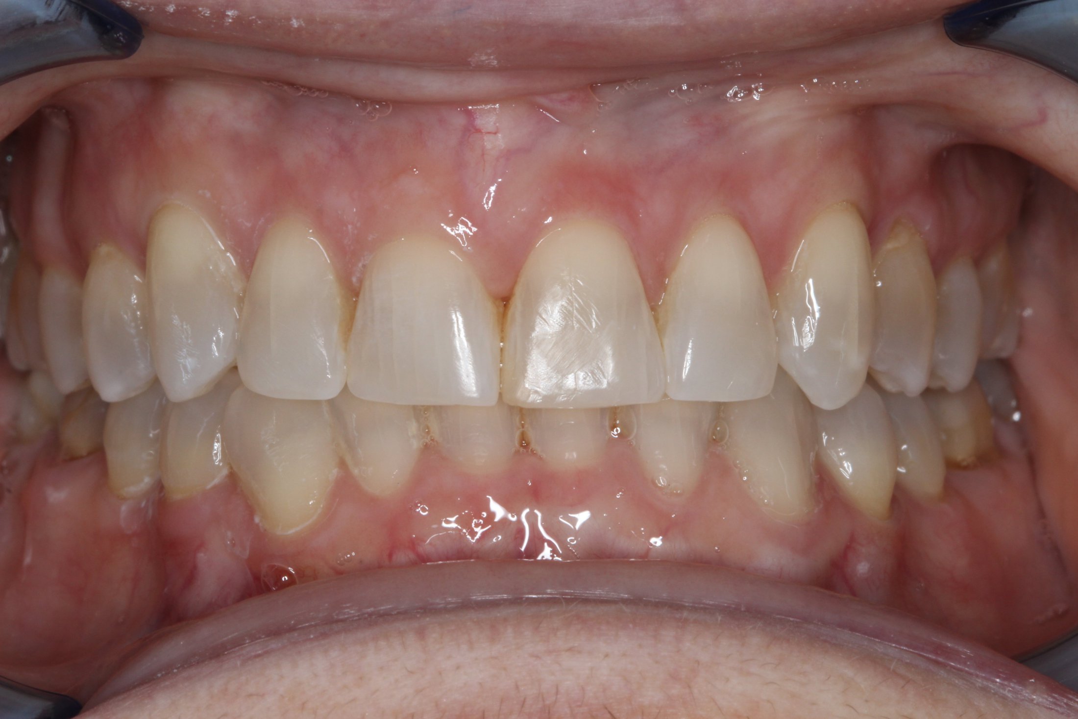 Patient's mouth after Invisalign