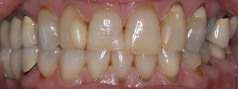 Patient's mouth before complete smile makeover